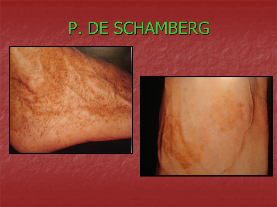 Purpura pigmentaria progresiva de schamberg